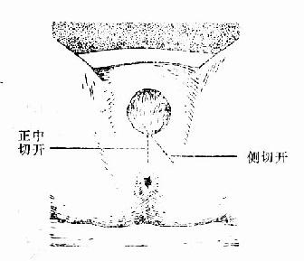 会阴切开部位示意图