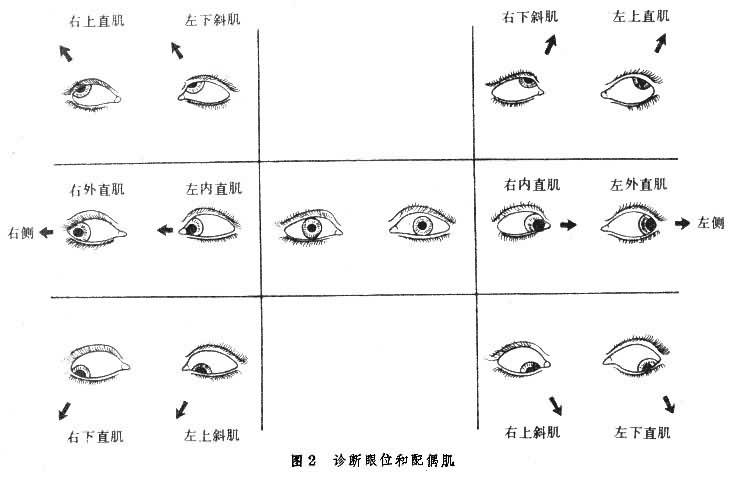 诊断眼位和配偶肌
