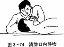 清除口内异物