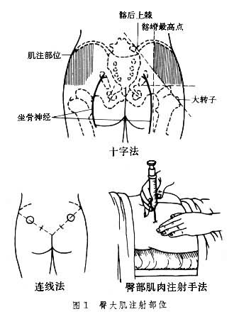 臀大肌注射部位